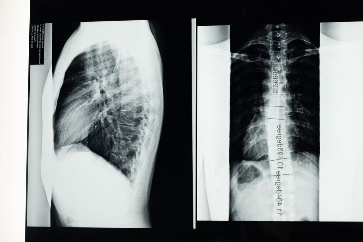 Two chest X-ray films displayed side by side on a lightbox.